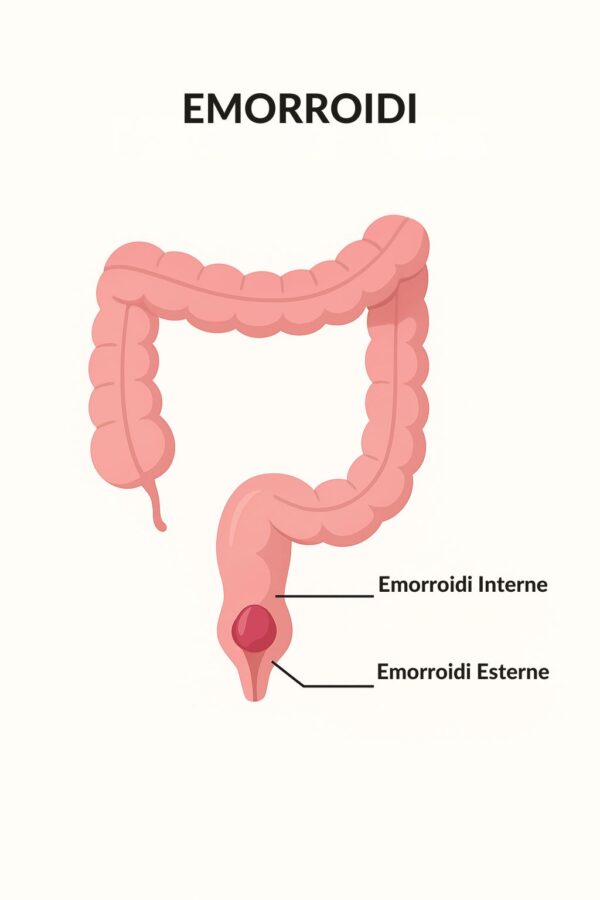 Che Cosa Sono le Emorroidi: Una Panoramica Medica